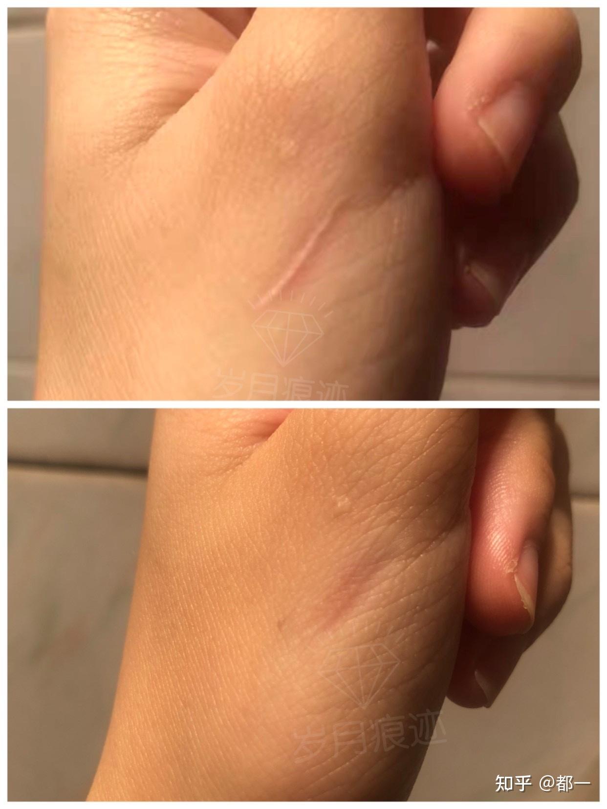 耐心坚持贴效果挺好的.特别是针对疤痕疙瘩.