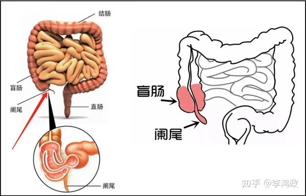阑尾炎,还会死人么? - 知乎