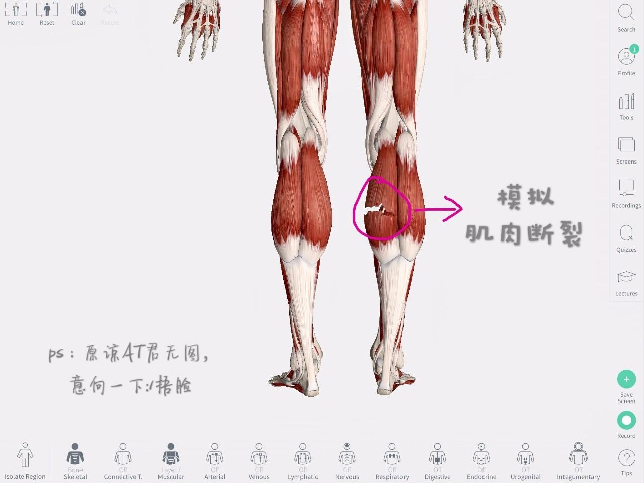 除了表现以外,还可以通过抗阻实验来确定损伤例腘绳肌拉伤抗阻实验