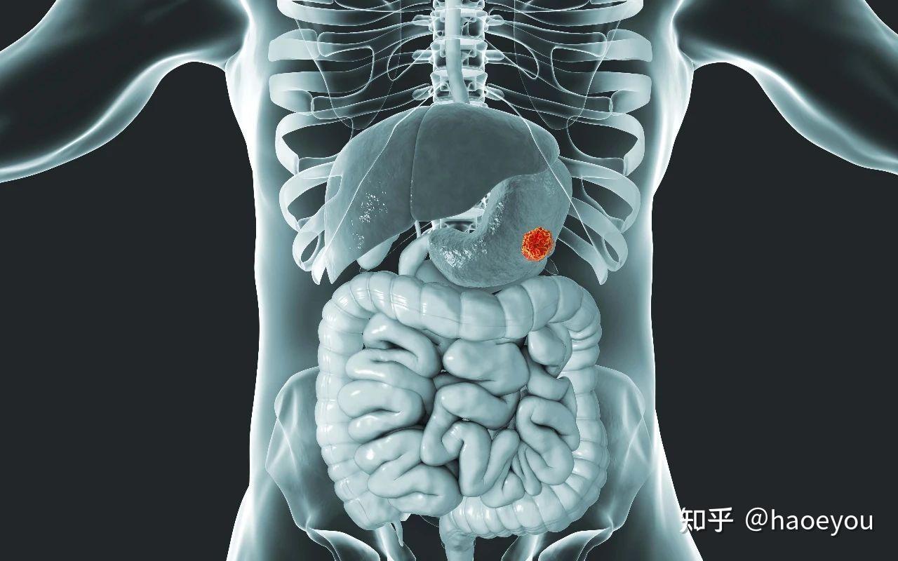 胃溃疡变成胃癌的几率大吗，早期胃癌有什么迹象，怎样发现呢？_大刘