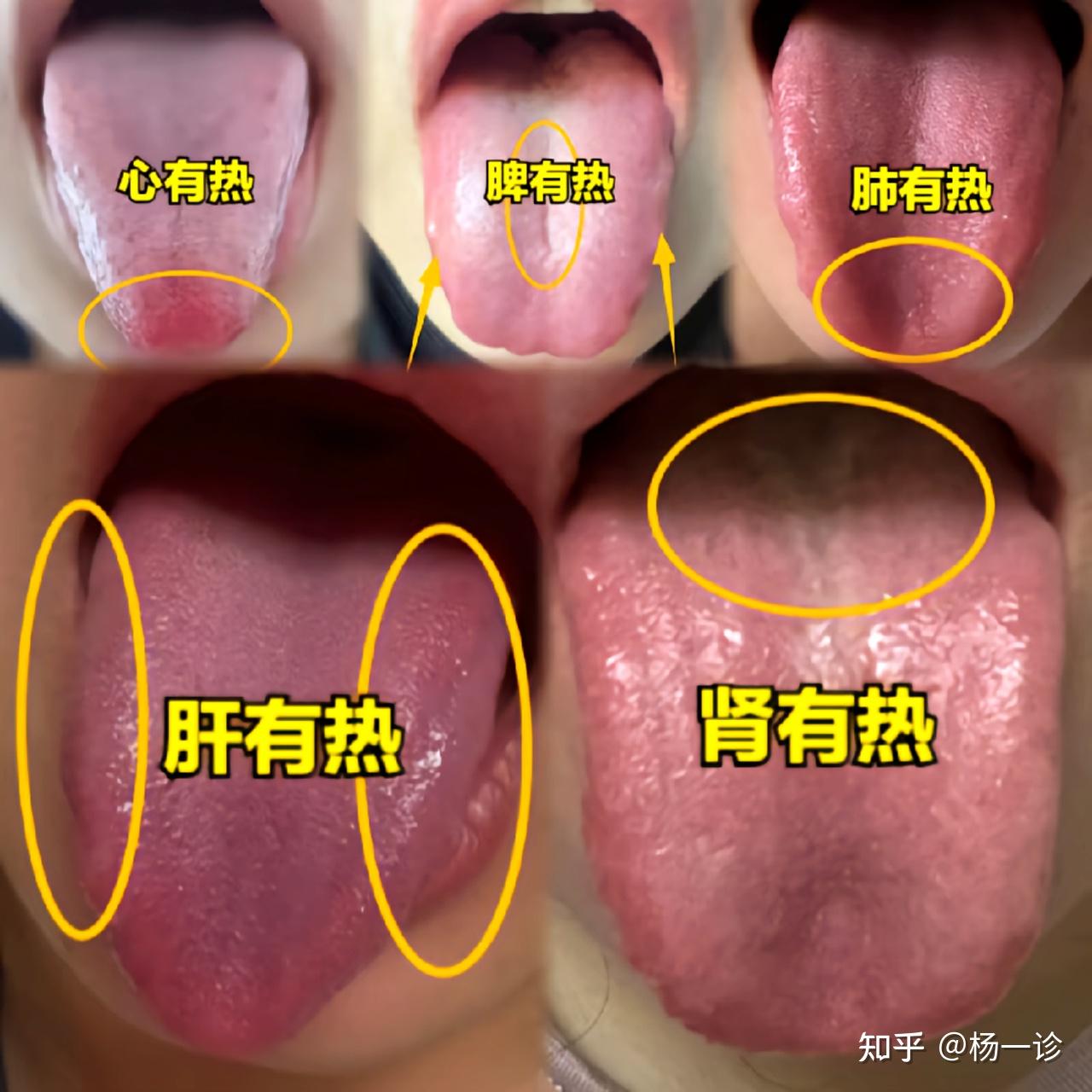 今天分享:五脏有热舌象,可以对比一下你是哪种? 肾。肾虚 - 知乎