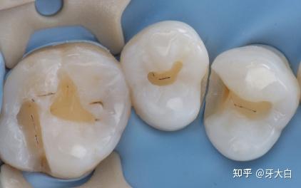 补牙后产生的酸疼不可避免吗? - 知乎