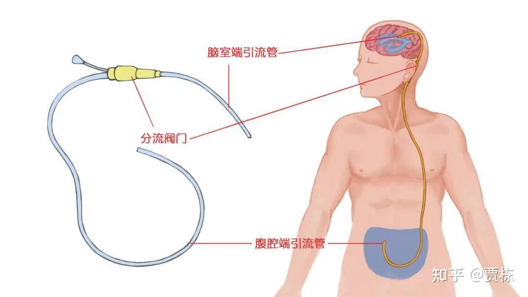 分流管分流手术是指借助分流管通过颅骨钻孔插入脑室内,引流管接上