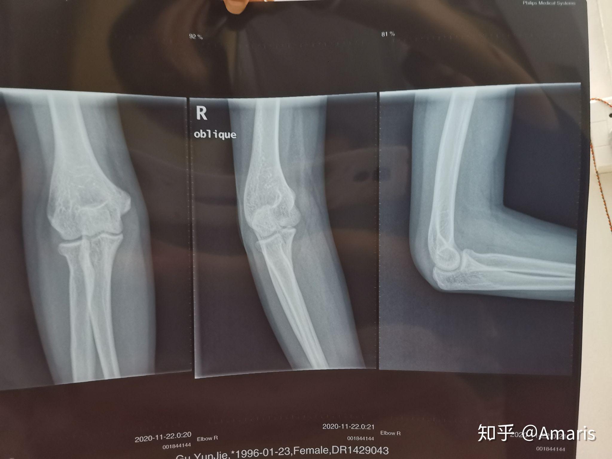手肘摔伤不能伸直和抬高拍了片子说是可能骨折了但是不确定有会看光片