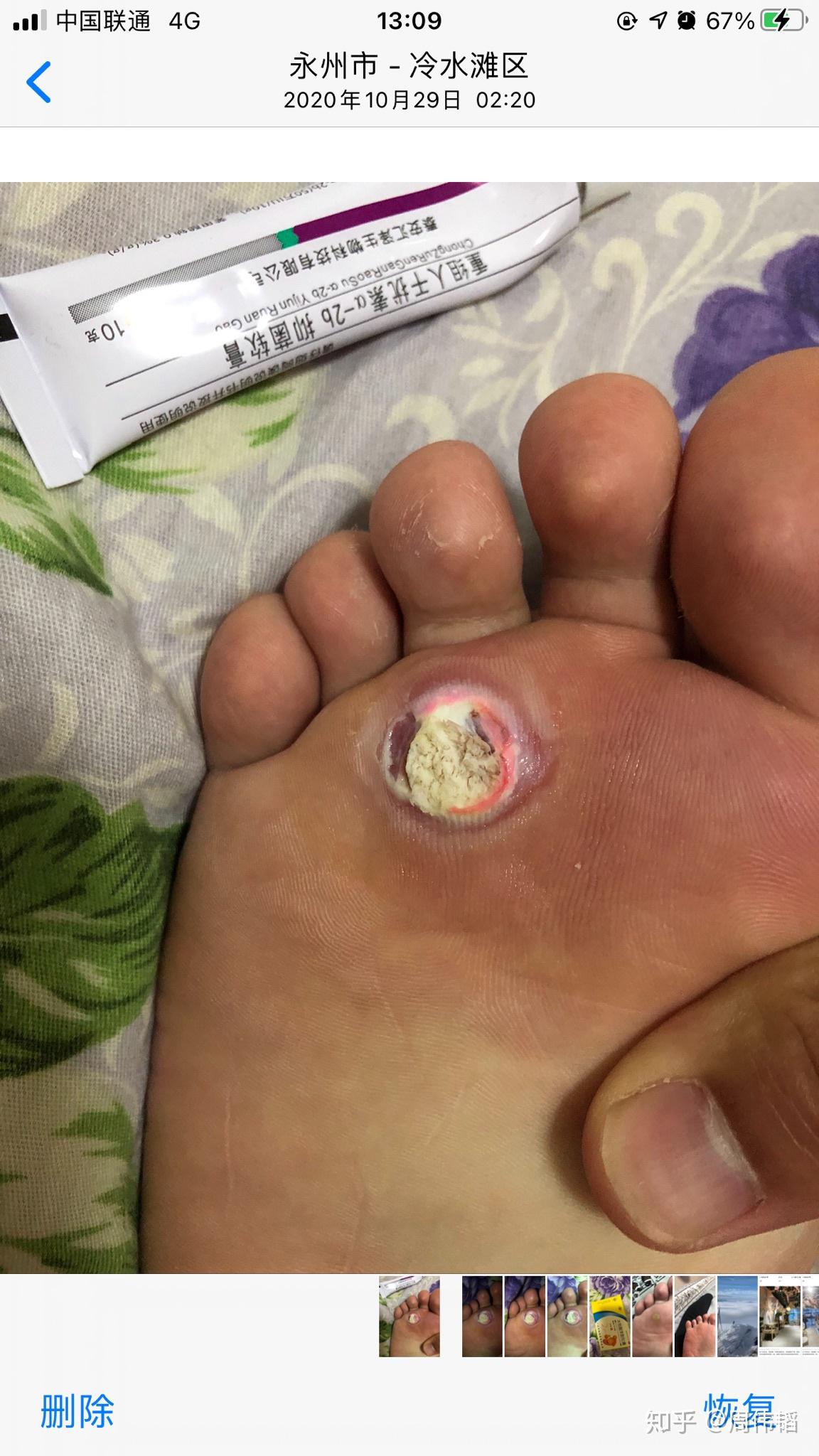 有次穿拖鞋被生锈的图钉扎了脚  就1,2毫米深不是很痛 没注意  还不