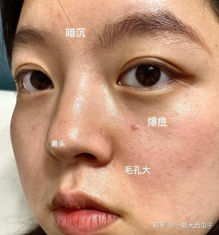 去黑头到底用什么才是对的? - 知乎