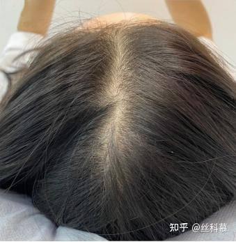 女生掉头发有发缝正常吗 - 知乎