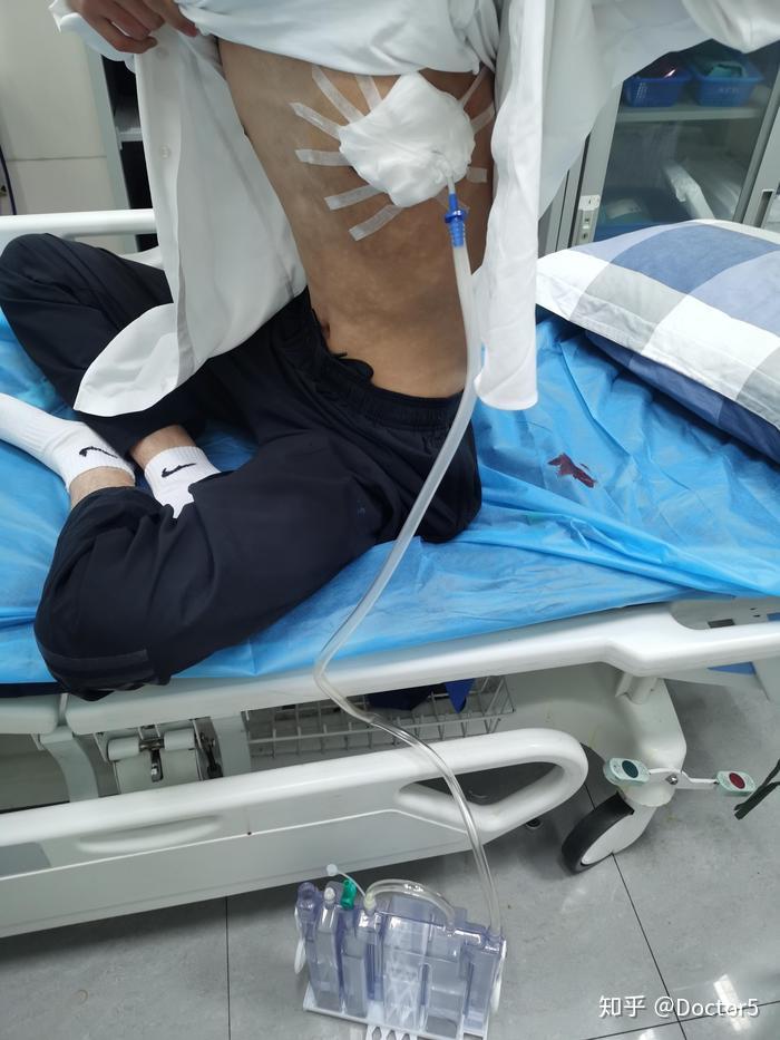 气胸诊疗全记录 考生高考第一天自发性气胸发作,他还能 完成高考么,会