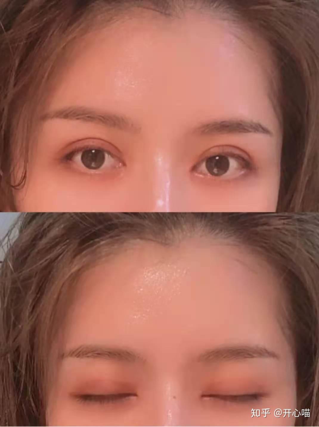 郑州哪些医生双眼皮做的好价格是多少