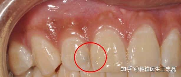 医生见了都会发出“嘶——”的邻面龋,到底有多可怕? - 知乎