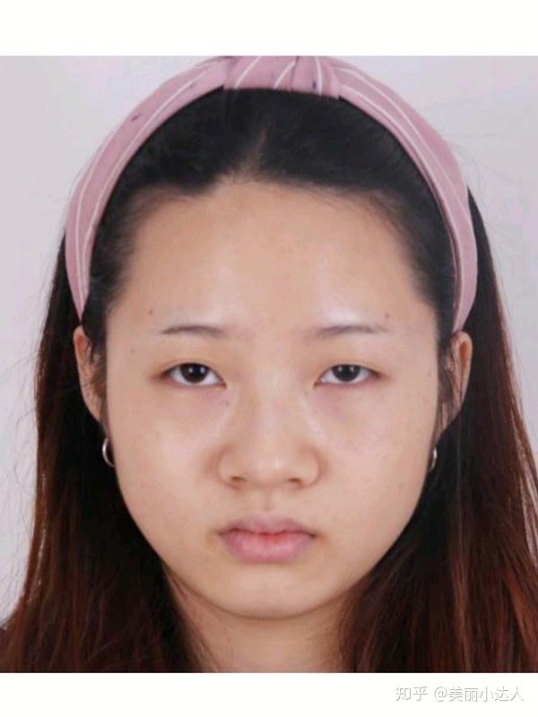 遗传了爸爸的大鼻子终于下定决心去隆鼻了