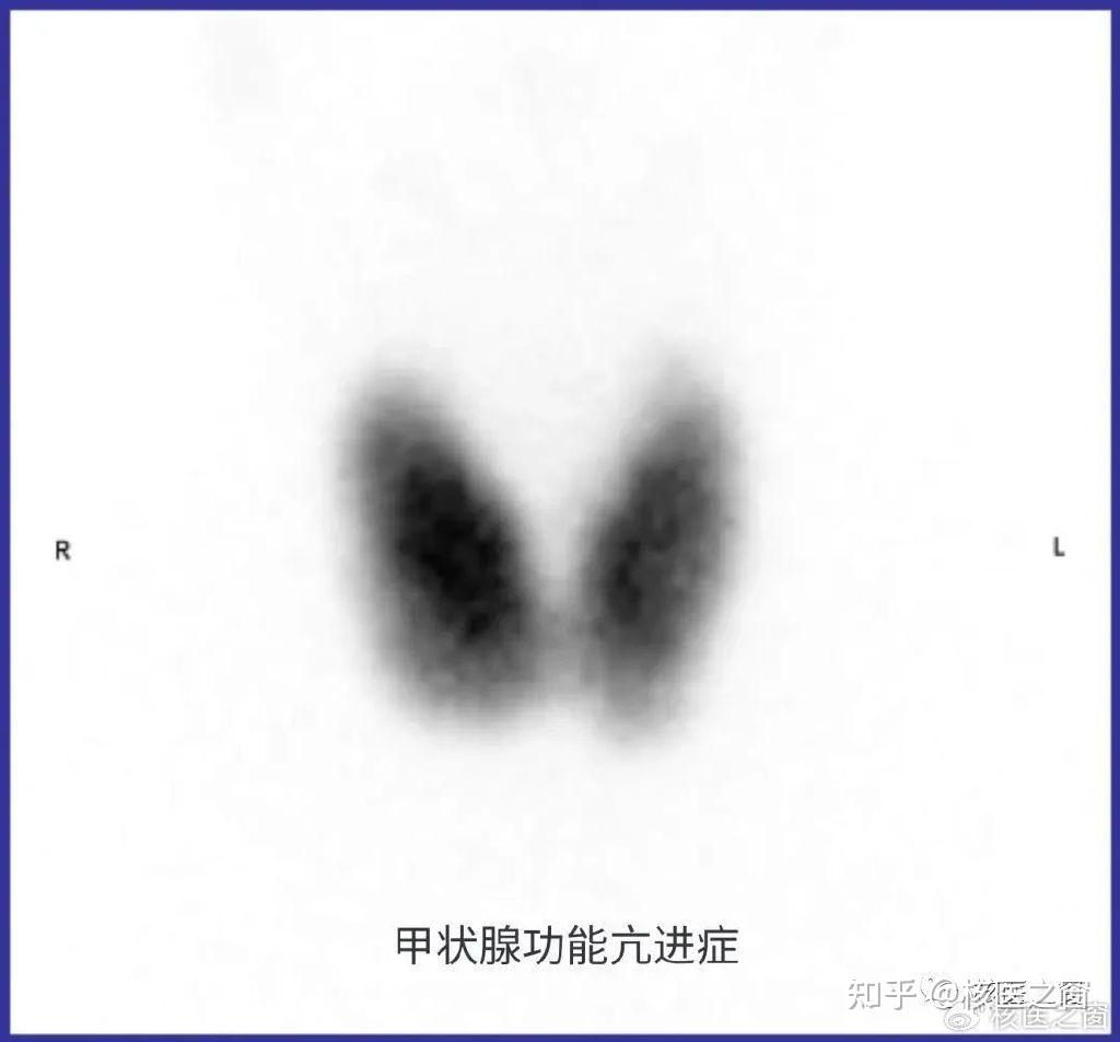 SPECT/CT临床应用 - 知乎
