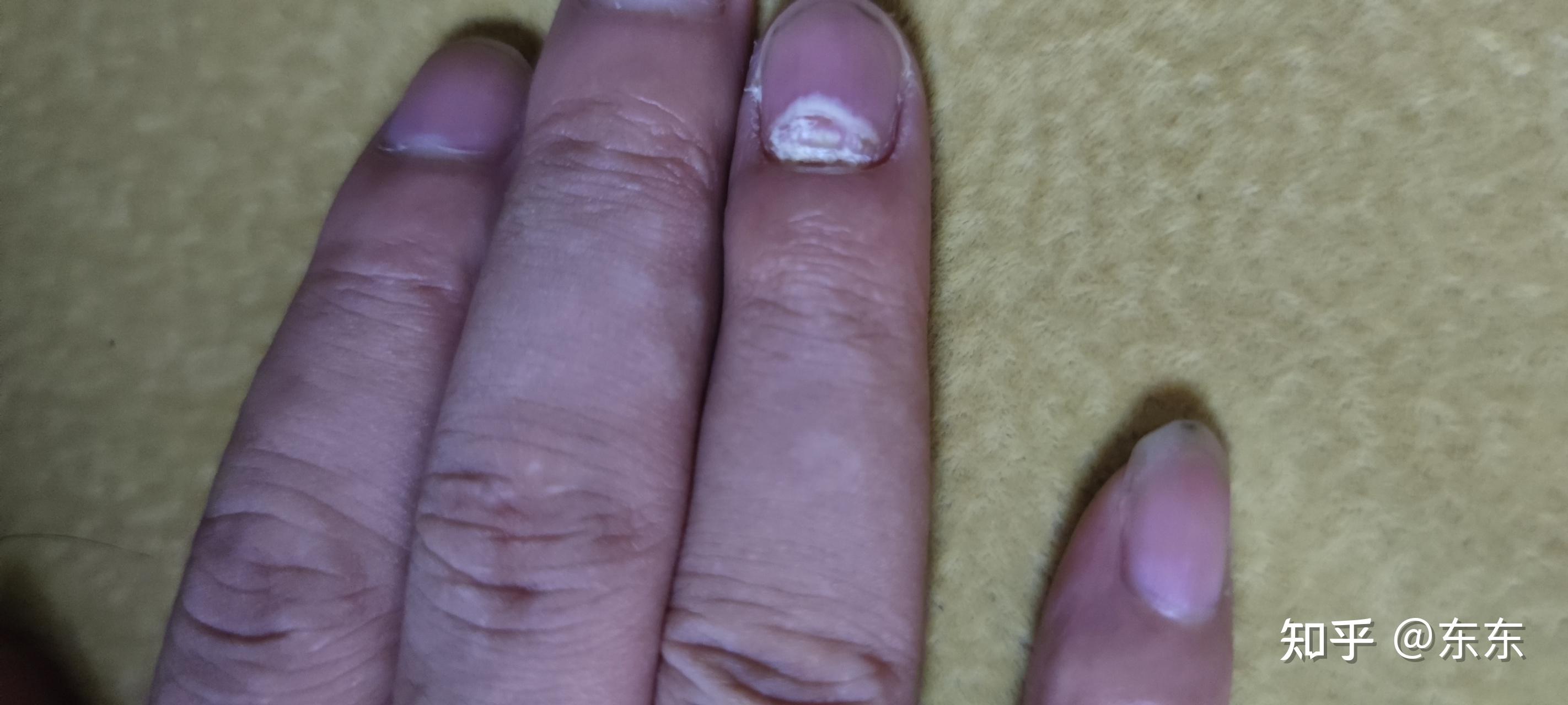请问指甲好端端的肉和月牙处凹陷脱离了