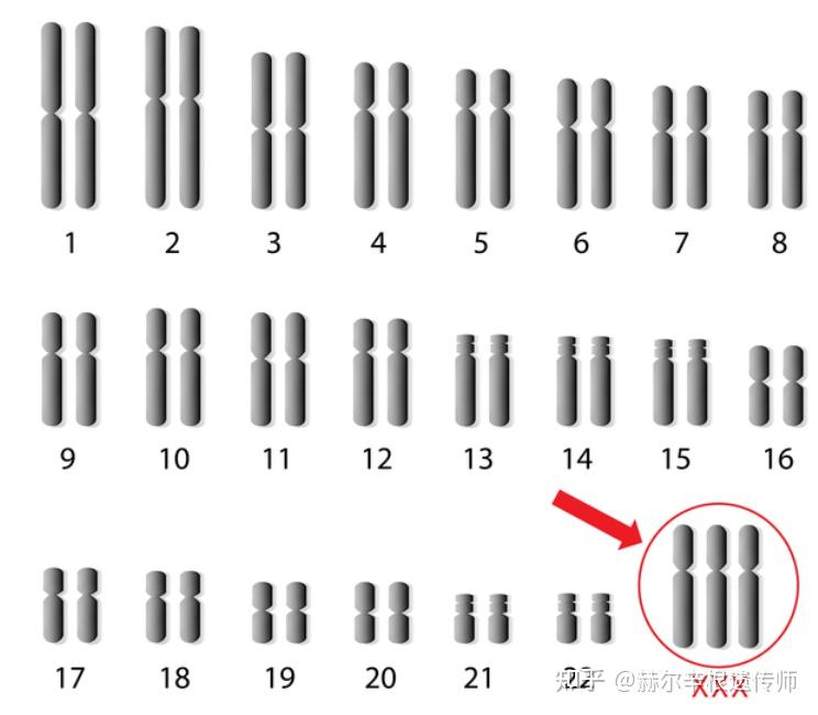 47,XXX综合征/超雌综合征疾病介绍及应对策略 - 知乎