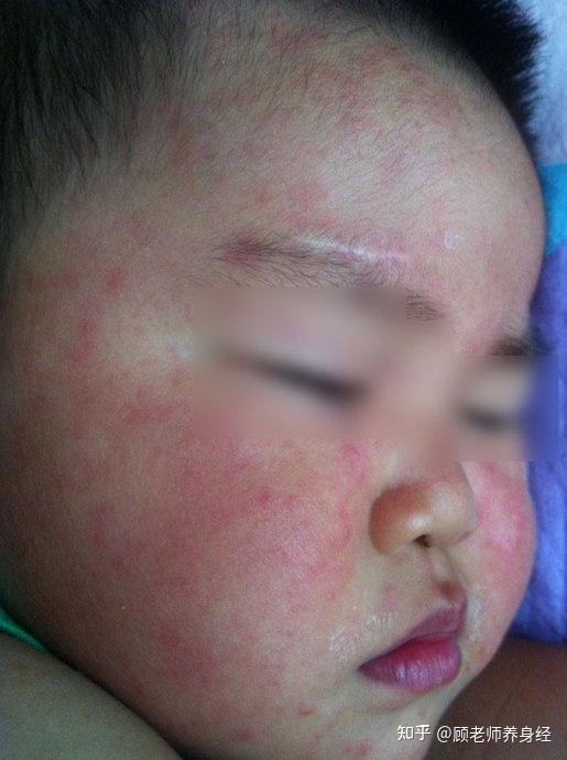 幼儿急疹是什么?幼儿急疹案例集合 - 知乎