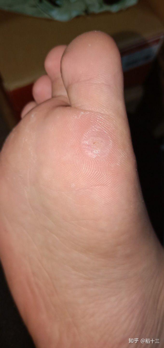 一颗足底跖疣记录