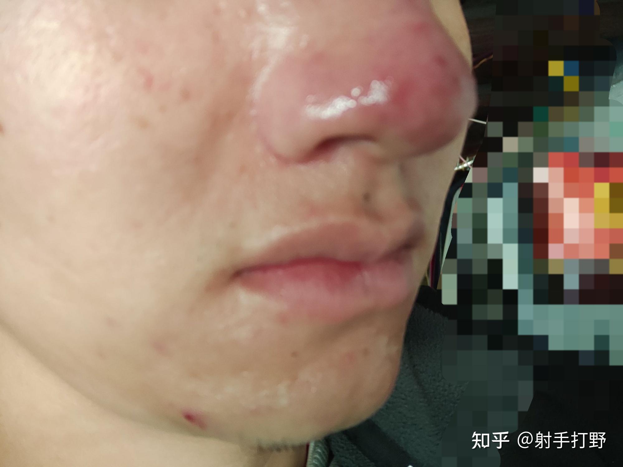 仅以此文记录我玫瑰痤疮(酒糟鼻)治疗过程 - 知乎
