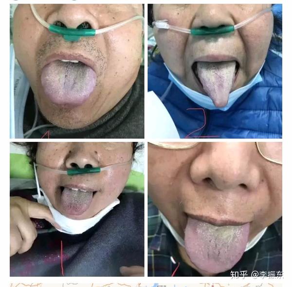 新型冠狀病毒,中醫治療思路參考,若有召必至