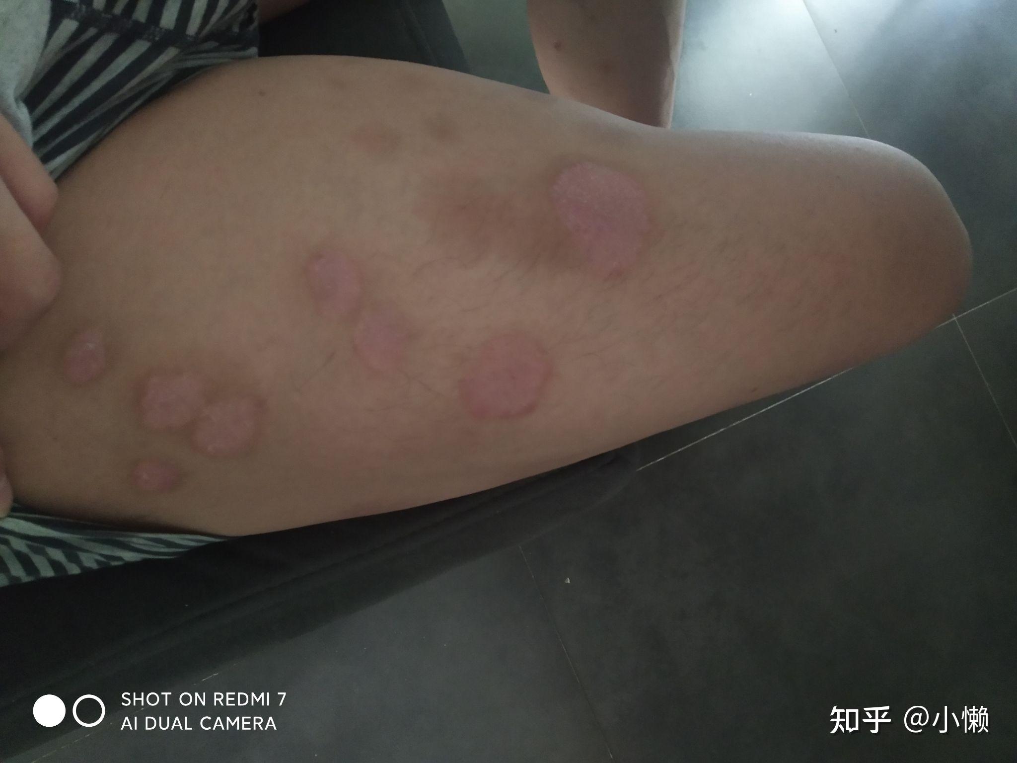 分享可善挺治疗效果,真实记录