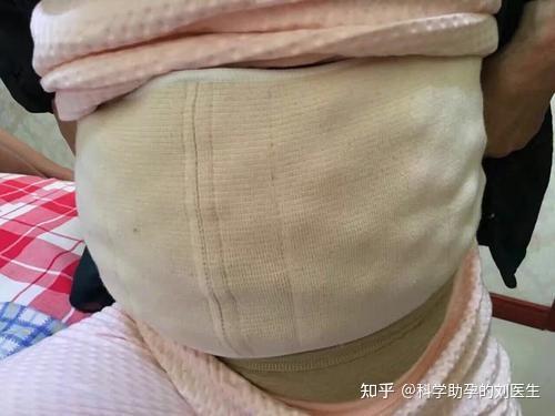 为什么取卵后会出现腹水?