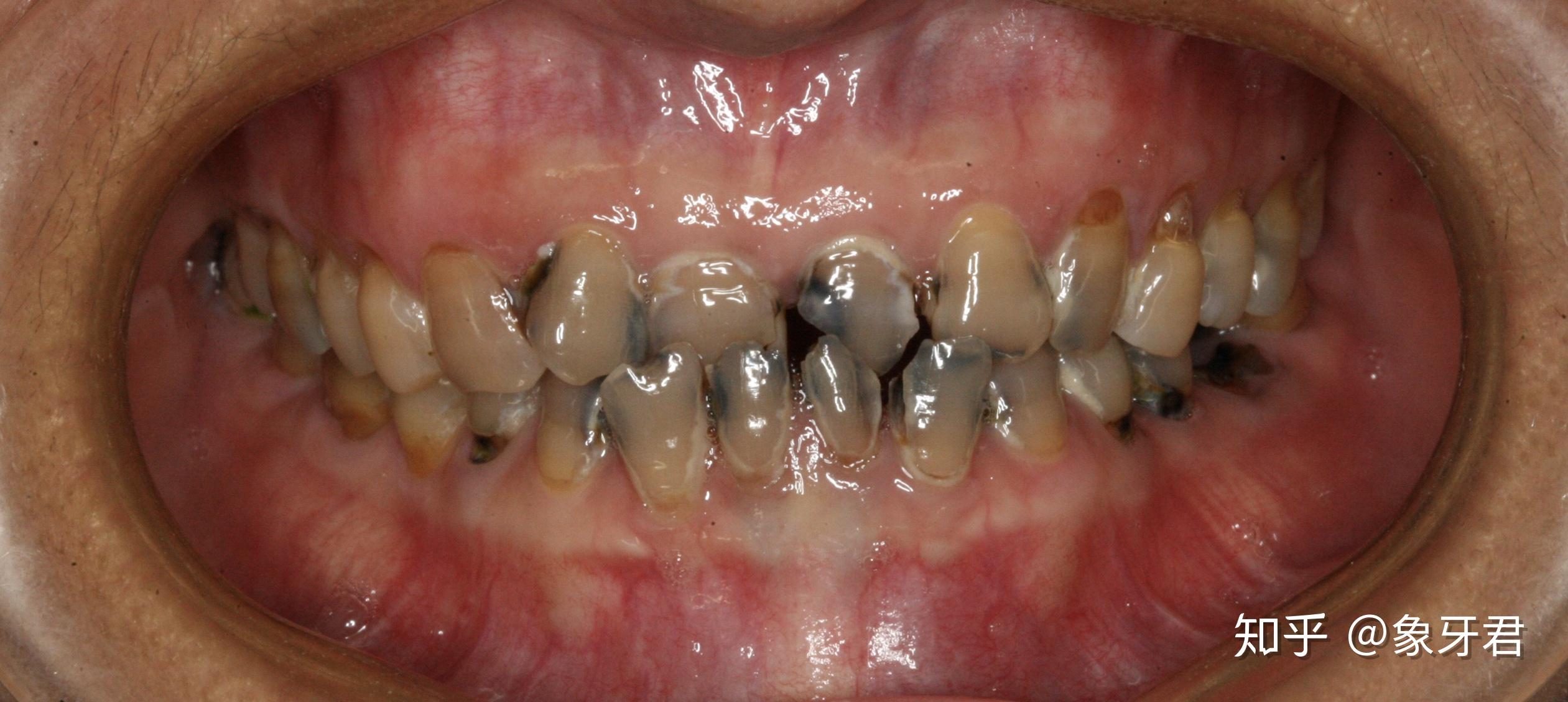 醫師，我的牙齒破掉了怎麼辦？------全瓷嵌體修復大範圍蛀牙 - 案例介紹 - 美容牙科張凱榮醫師
