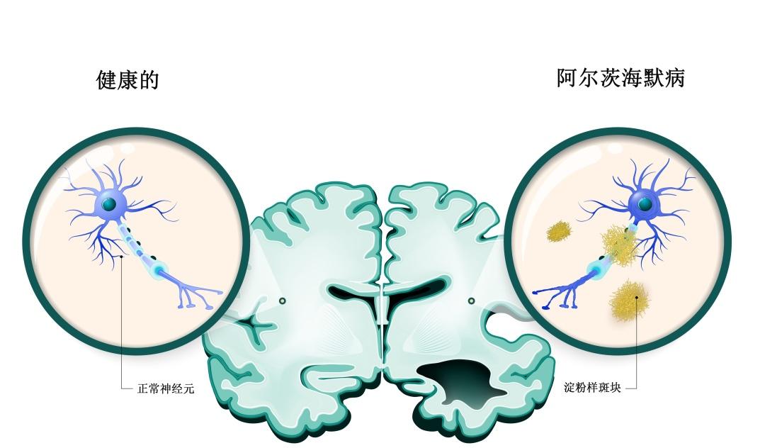 神经系统性疾病现状:一场全球性的健康挑战 - 知乎