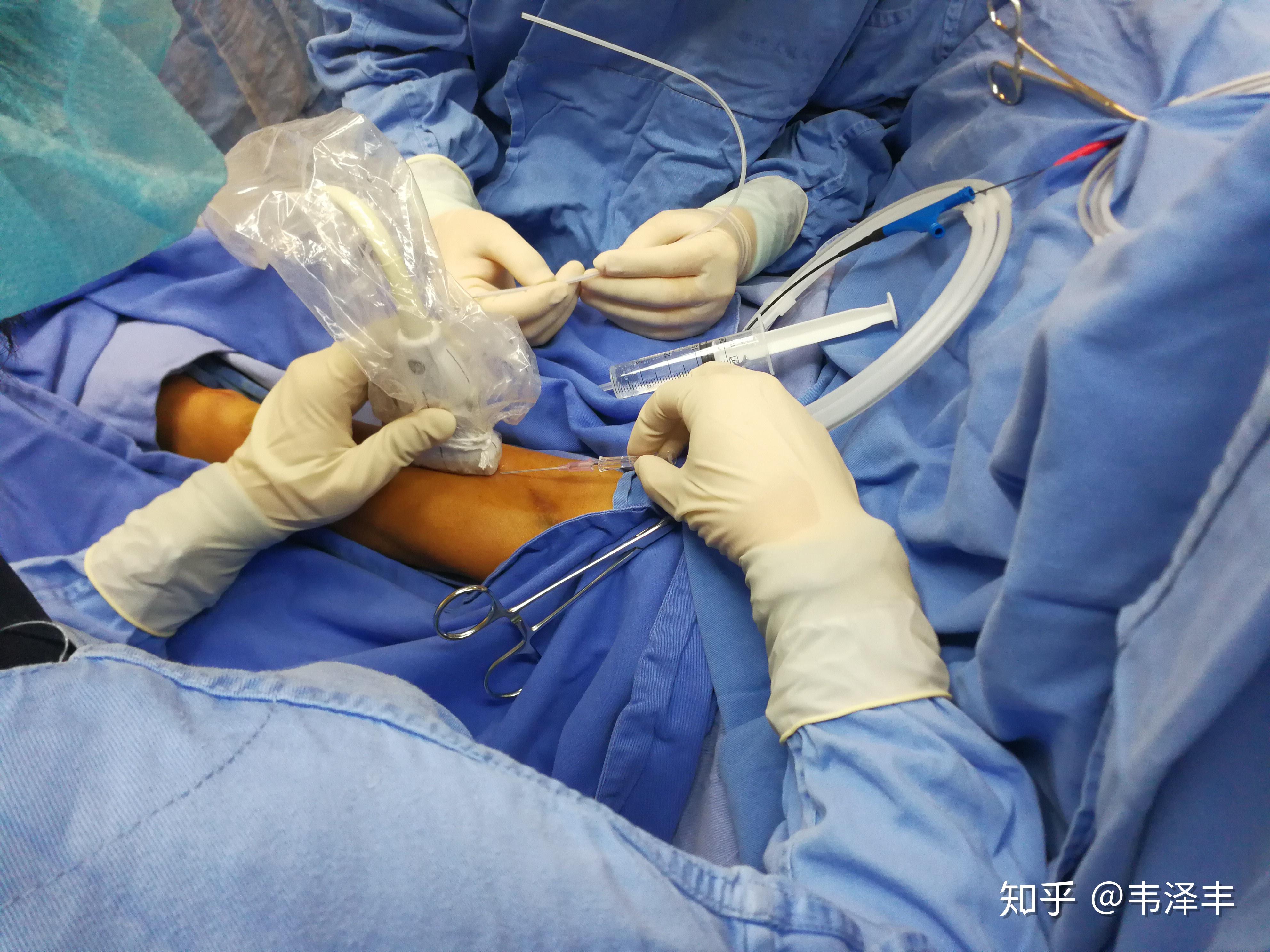 b超引导下内瘘溶栓球囊扩张术