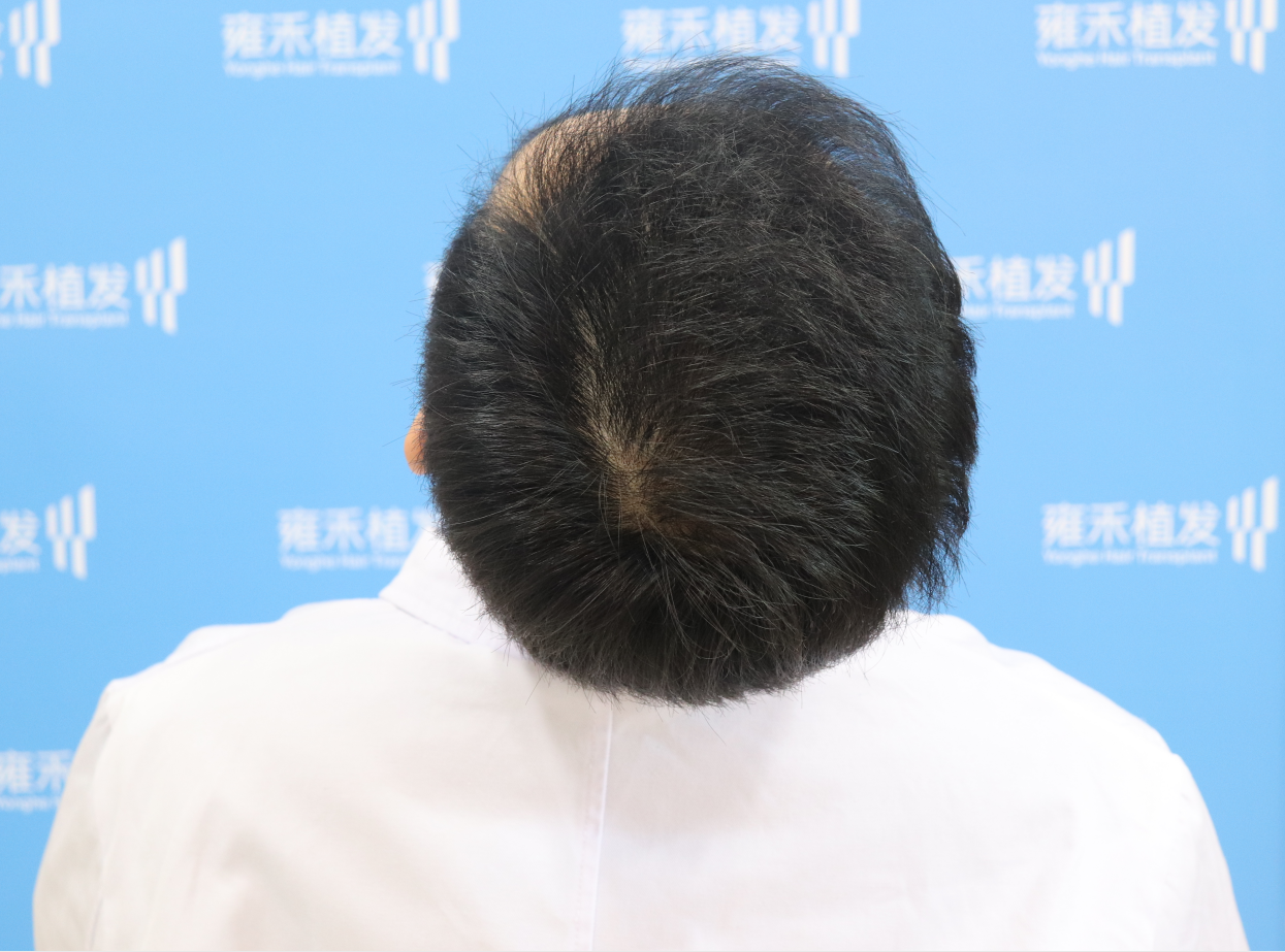 脱发严重植发头顶稀疏恢复日记常更