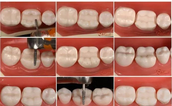 案例分享高嵌体的预备及注意事项