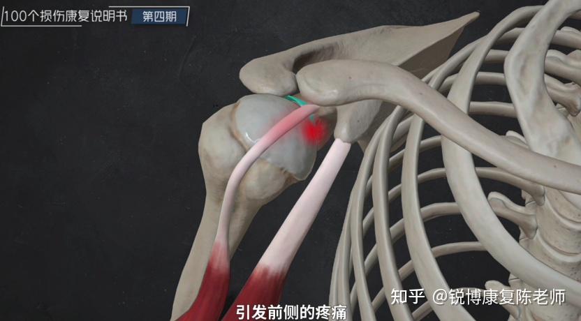 【锐博康复科普】【肩膀前侧疼】俯卧撑做不起来？可能是肱骨前移！ - 知乎