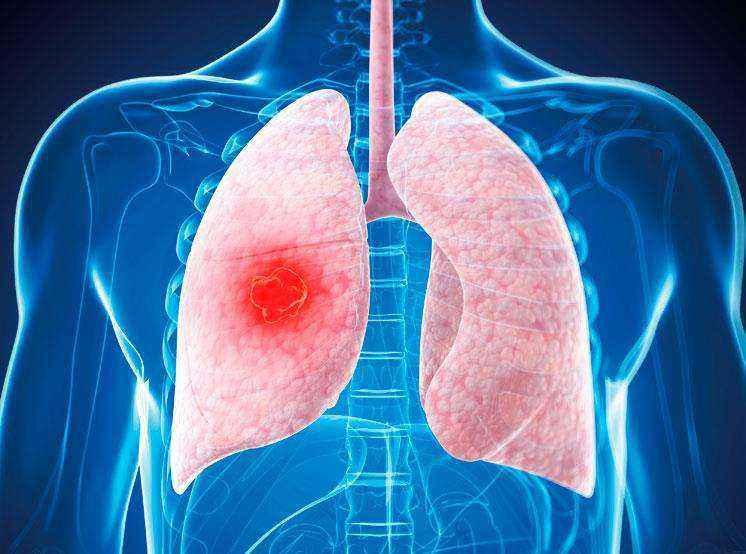 肺癌早 中 晚期怎么分 如何判断肺癌的严重程度 知乎