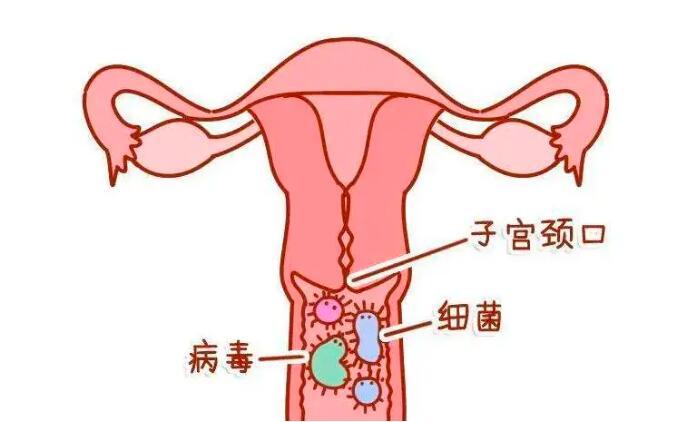 女性宮頸尖銳疣病什麼症狀