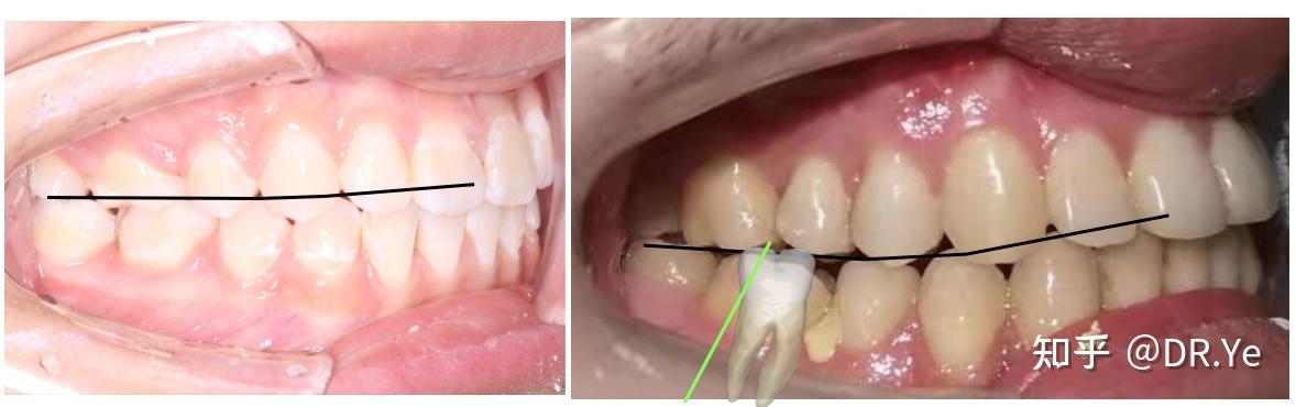 在于上下牙列纵合曲线的控制(医生常说的spee(斯匹)曲线)绿线代表了