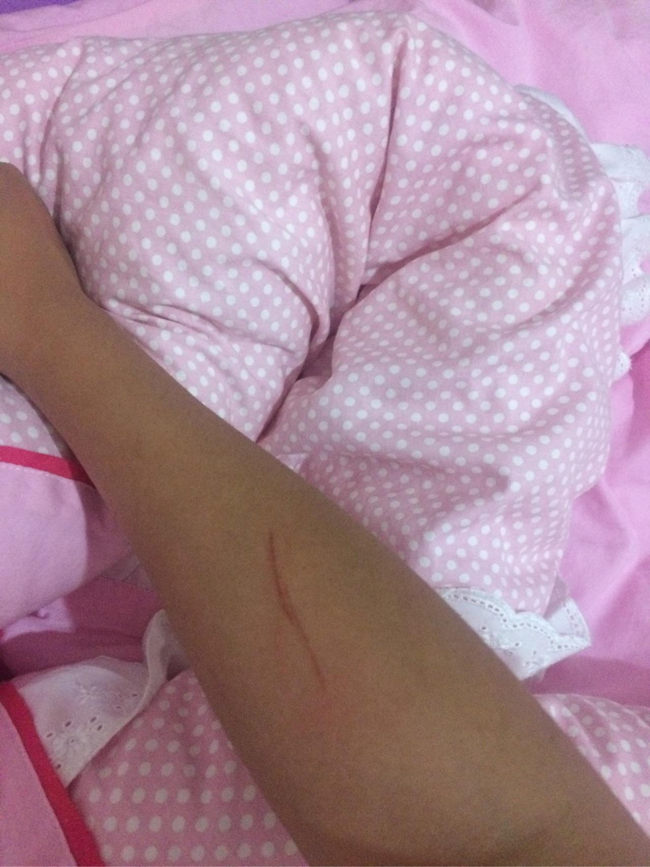 被自家养的狗爪子划破了狗狗打了两针疫苗没打完没打狂犬我有事吗要