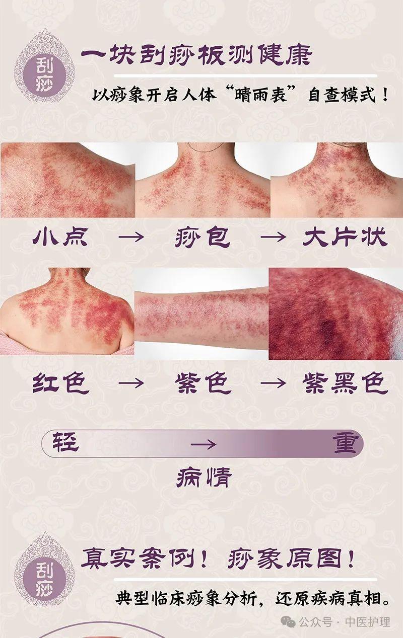 中医治疗慢性阻塞性肺疾病——虎符铜砭刮痧 - 知乎