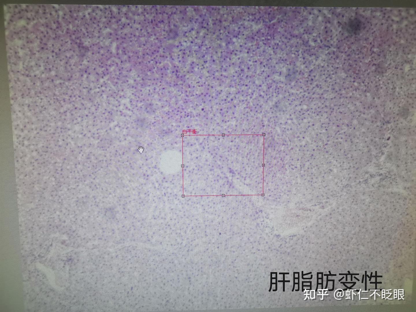 病理学切片及描述 - 知乎