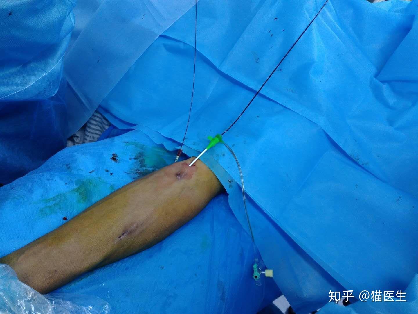 介入技术之导丝成袢技术和会师