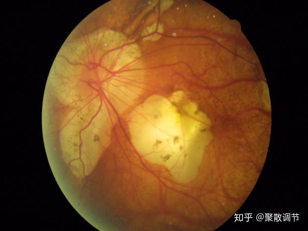 高度近视脉络膜视网膜萎缩