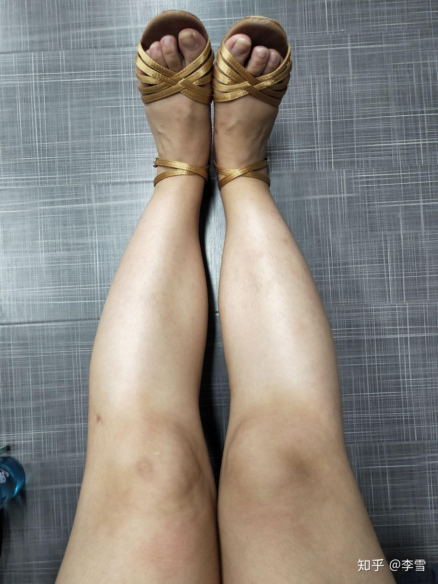 腿不直是什么原因传说中的xo型有什么补救措施吗已上图