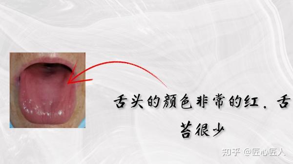 肾虚不虚，舌象告诉你！ - 知乎
