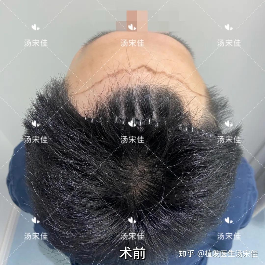 男性发际线植发1年,1842毛囊单位 - 知乎