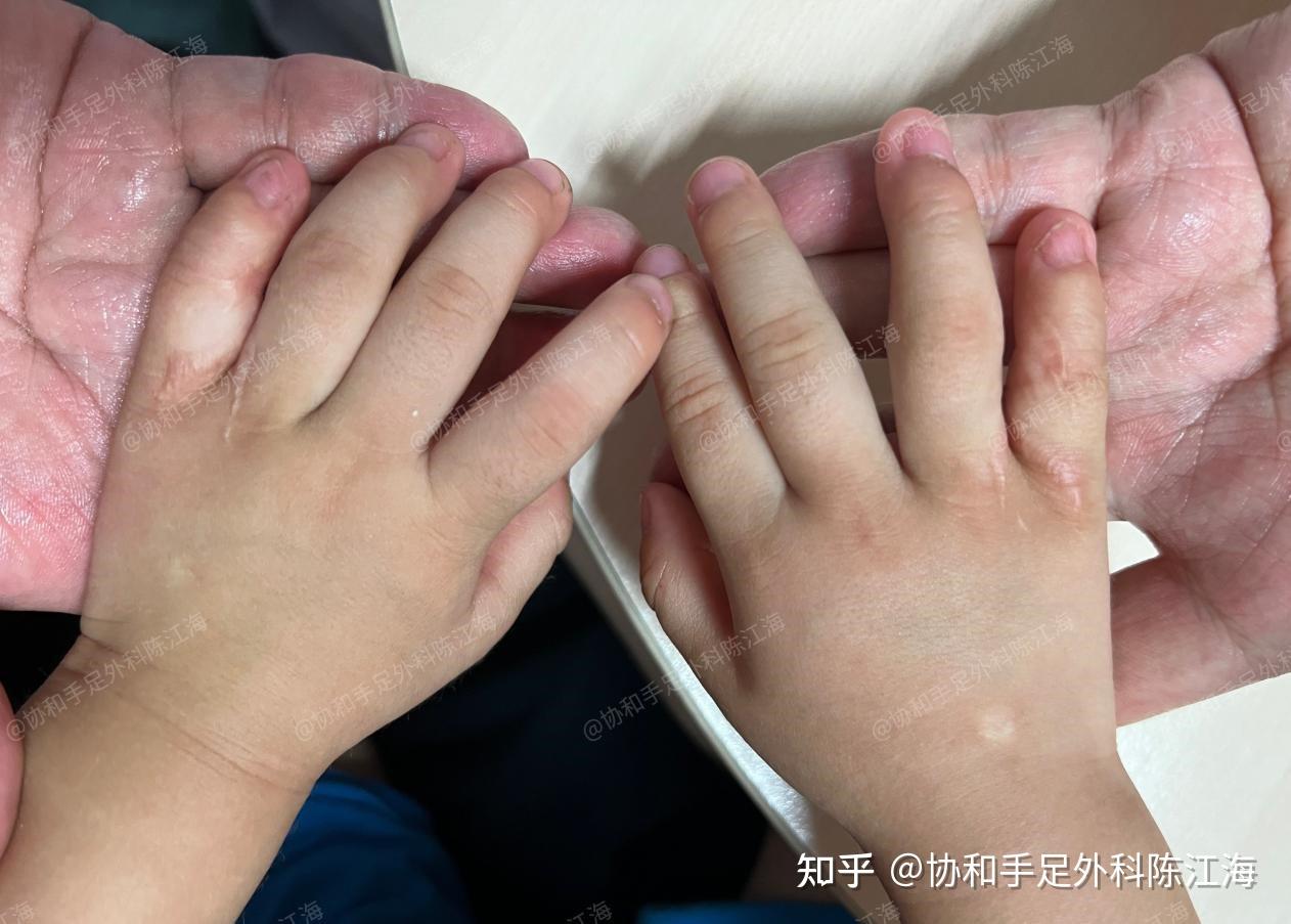 环,小指的并指,应尽早手术