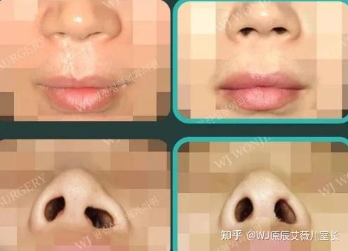 唇腭裂、口唇鼻裂患者想要改善怎么办,看韩国WJ原辰修复再造案例! - 知乎