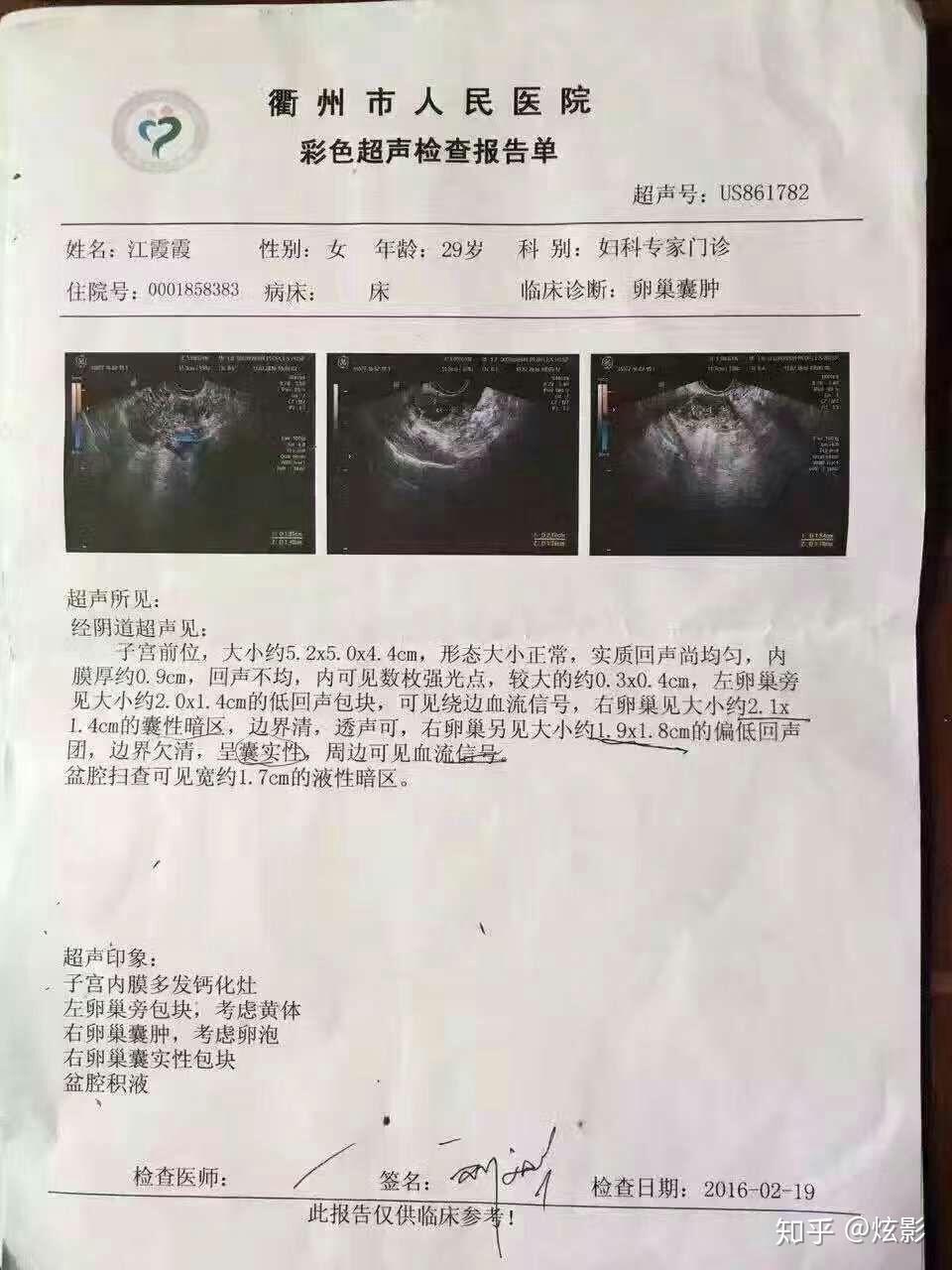 你瞭解婦科囊腫和盆腔積液嗎