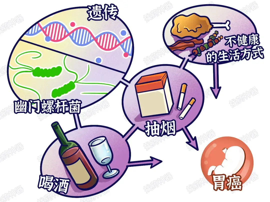 胃癌的发生发展是多种因素共同参与的复杂过程,其中遗传因素,幽门螺