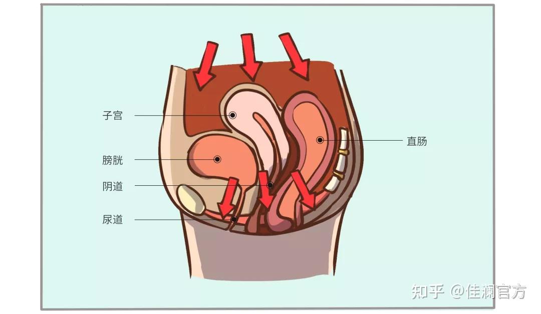 為什麼盆底康復不能拖到二胎再做