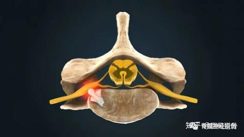 神经根型颈椎病的发病原因机制? - 知乎