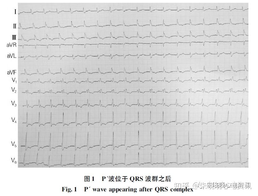 临床易被忽略和误诊的P波改变心电图解析 - 知乎