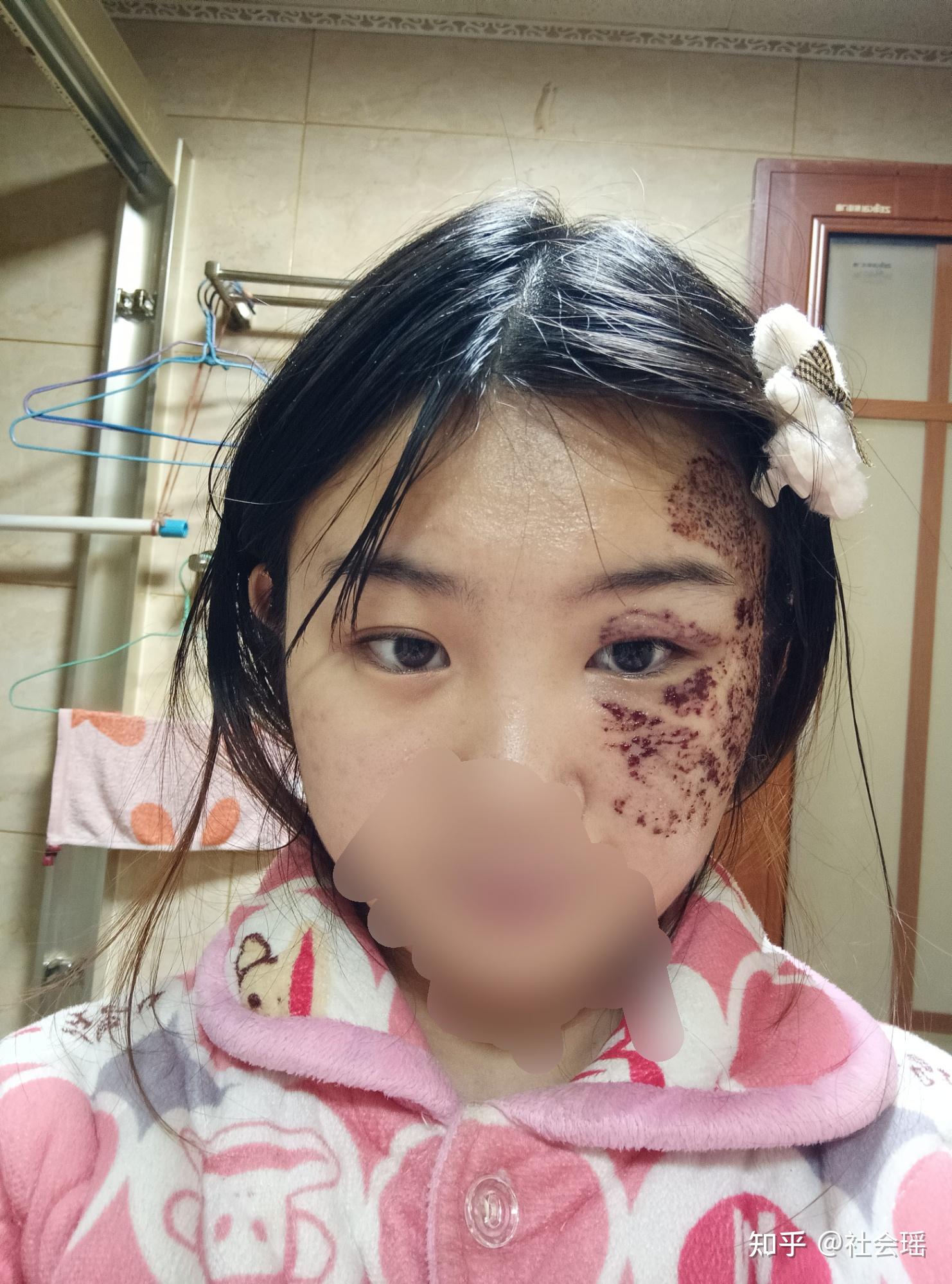 记录太田痣调q激光治疗 - 知乎