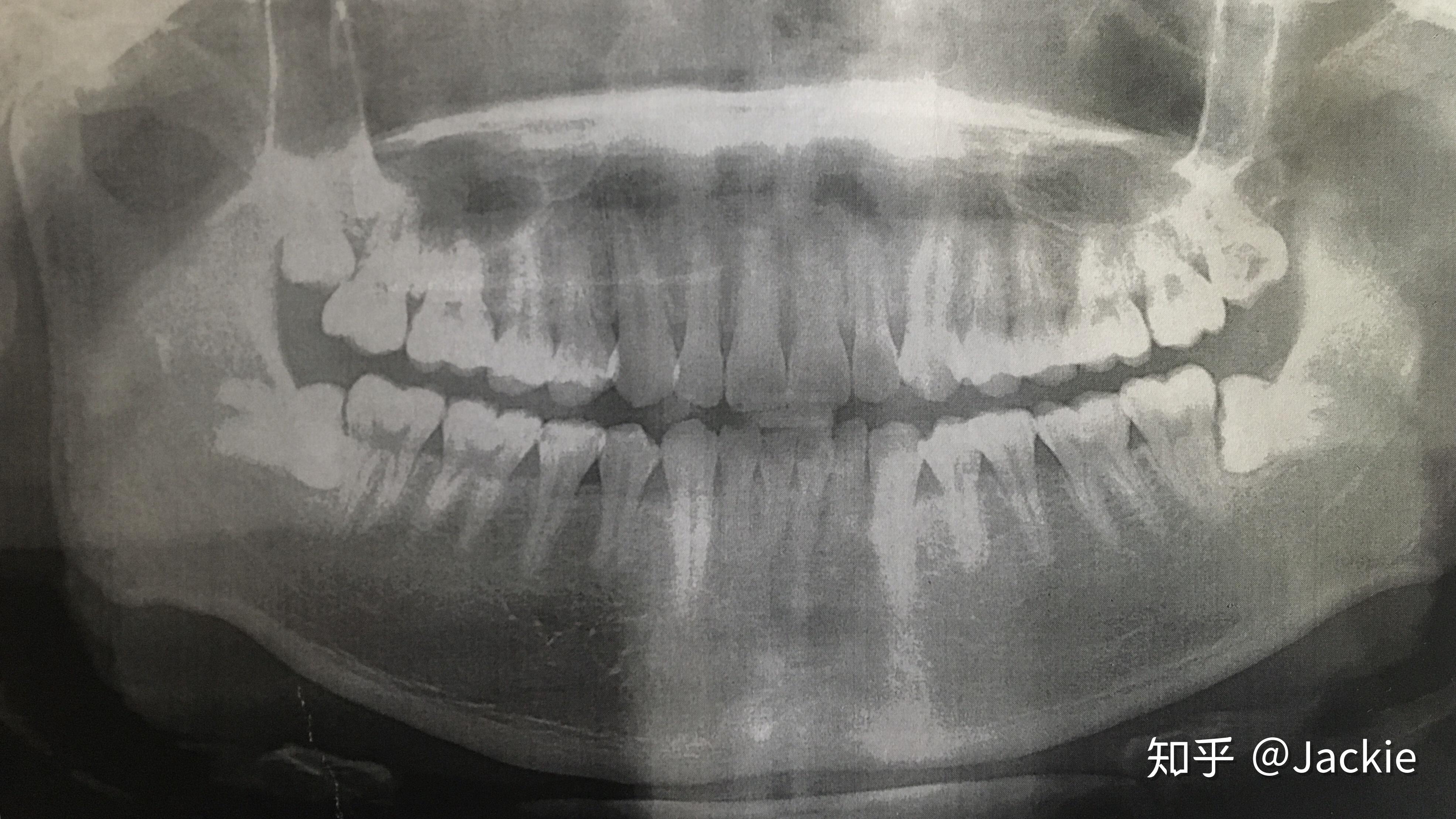 前歯のすきま 右上の小臼歯の垂直的骨吸収を抜歯で解決｜（医）精密審美会